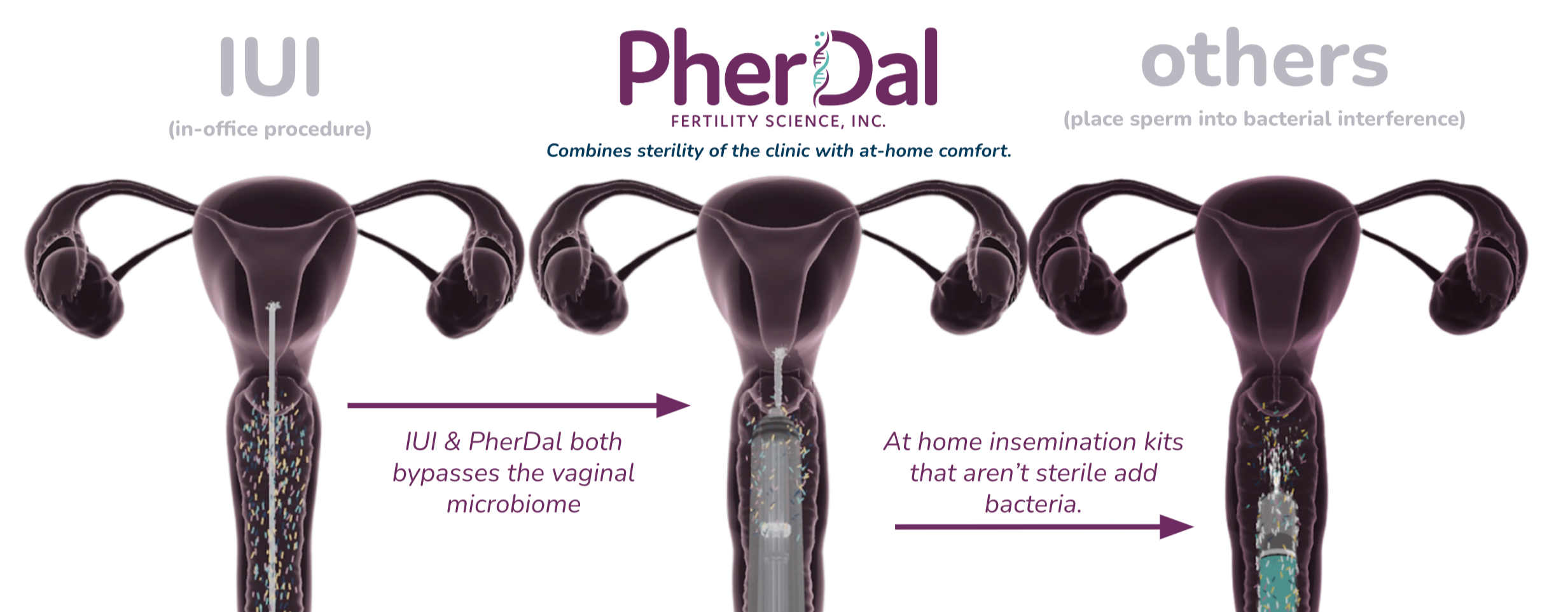 PherDal is the only ICI kit cleared by the FDA for sterile insemination as close to IUI as you can try