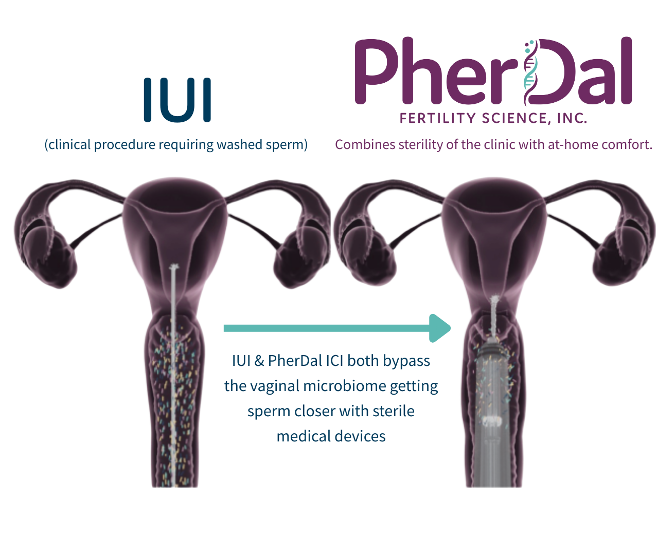 At home insemination IUI PherDal reviews
